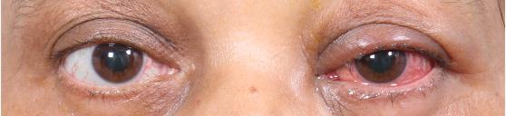 片方の目が強く充血した、感染した患者さんの両目の写真 / Photo of a patient's eyes, one severely bloodshot
