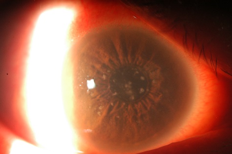角膜上皮に散在する顆粒状浸潤を示す細隙灯顕微鏡写真 / Slit-lamp photo: granular corneal epithelial infiltrates